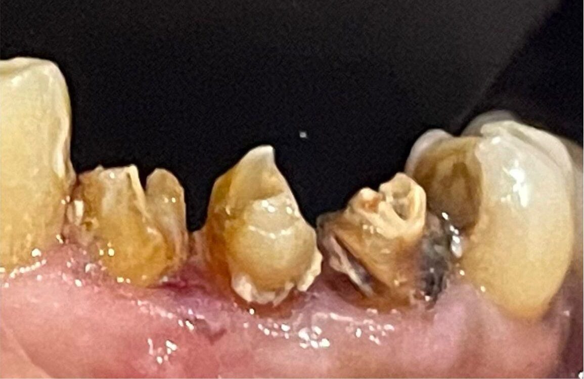 Before - Tooth Dental Implant