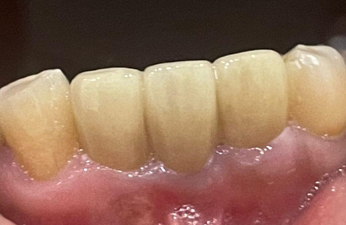 After - Tooth Dental Implant