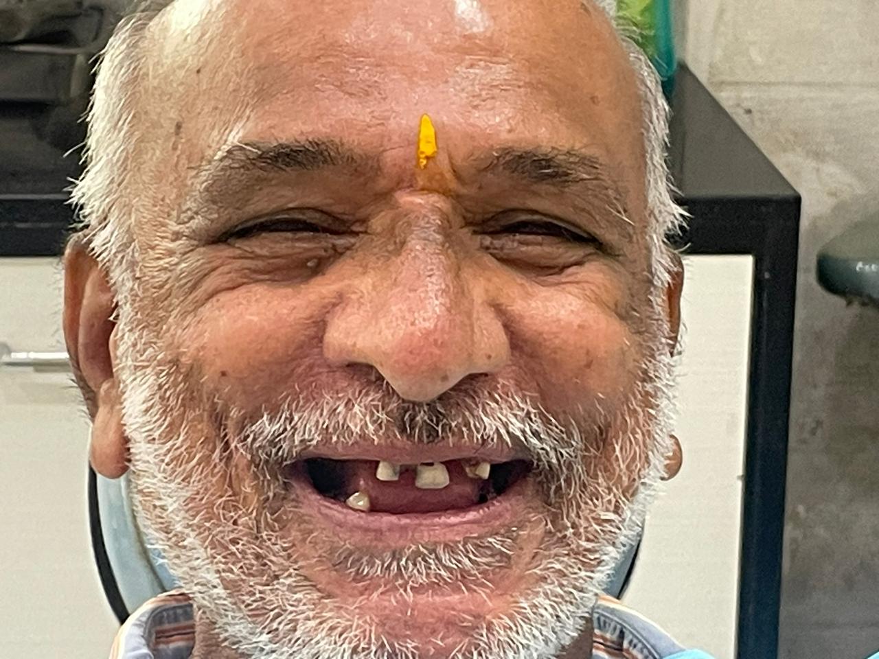 Before - Implant Treatment